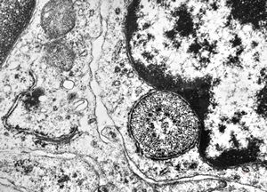 M,41y. | ribosome-lamella complex in tricholeukocyte -hairy cell leukemia, spleen